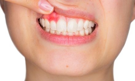 PERIODONTITIS O PIORREA – Descubre la «enfermedad de las encías»