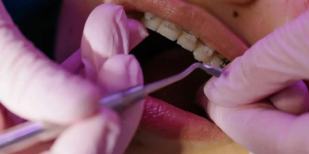 BRACKETS INVISIBLES DE ZAFIRO: la opción estética y resistente para tu ortodoncia