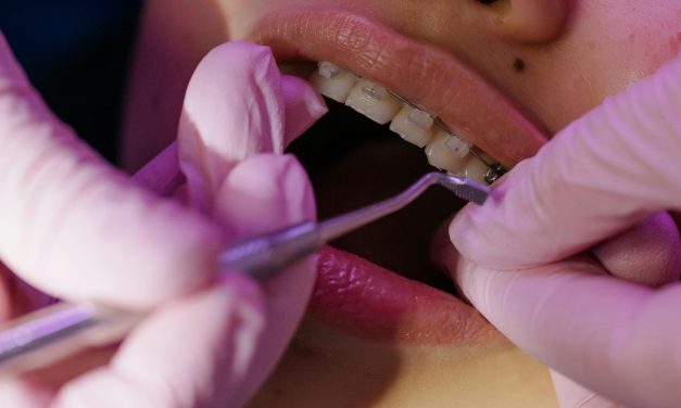 BRACKETS INVISIBLES DE ZAFIRO: la opción estética y resistente para tu ortodoncia